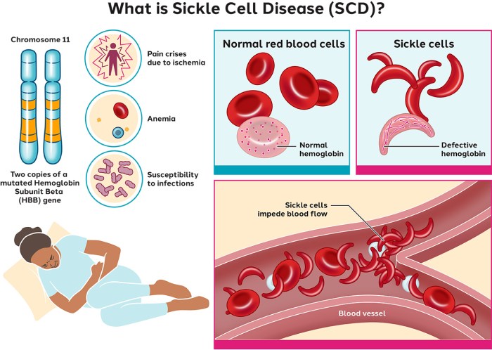 Sickle cell disease nclex questions